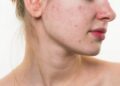 dấu hiệu dị ứng sữa ong chúa